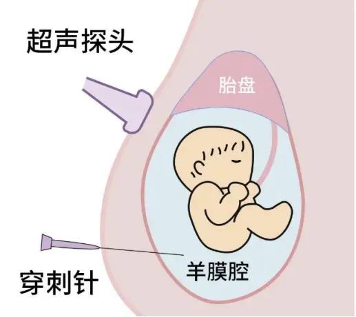 孕期必讀：產(chǎn)前篩查≠產(chǎn)前診斷，區(qū)別在這里！
