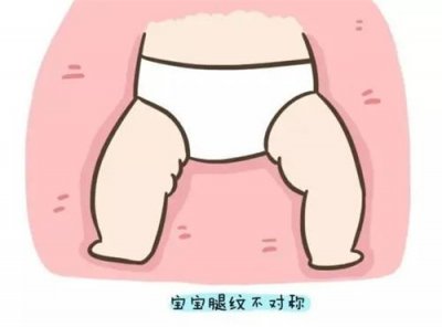 寶寶腿紋、臀紋不對稱，就是髖關節(jié)發(fā)育不良？