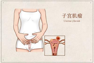 得了子宮肌瘤，一定要手術(shù)切除嗎？